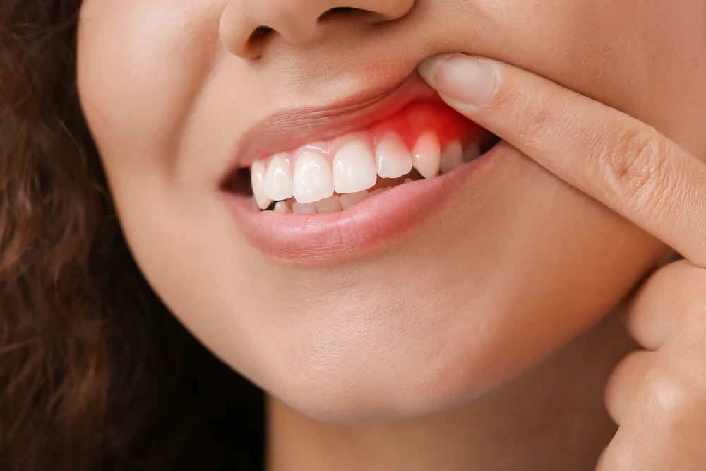 Gum Treatment